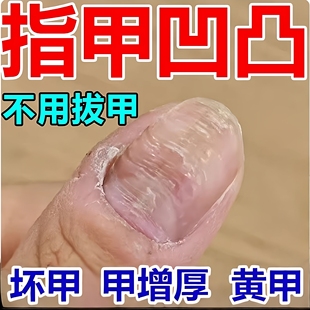 指甲凹凸不平修复液手脚指甲受损凹陷有竖纹分层护理专用神器