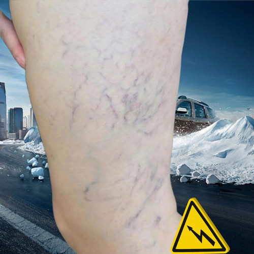 蚯蚓腿膏腿上有血管变紫盘曲凸出青筋红血丝水肿抽筋刺痛腿酸困麻