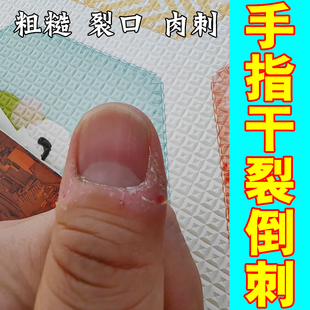 去手上干裂脱皮倒刺肉刺指甲缝脱皮裂口起硬皮修复专用保湿霜裂纹