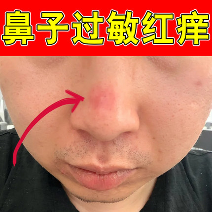 鼻子过敏红痒内分泌失调上火熬夜皮肤过敏螨虫鼻酒糟脂溢性修护药