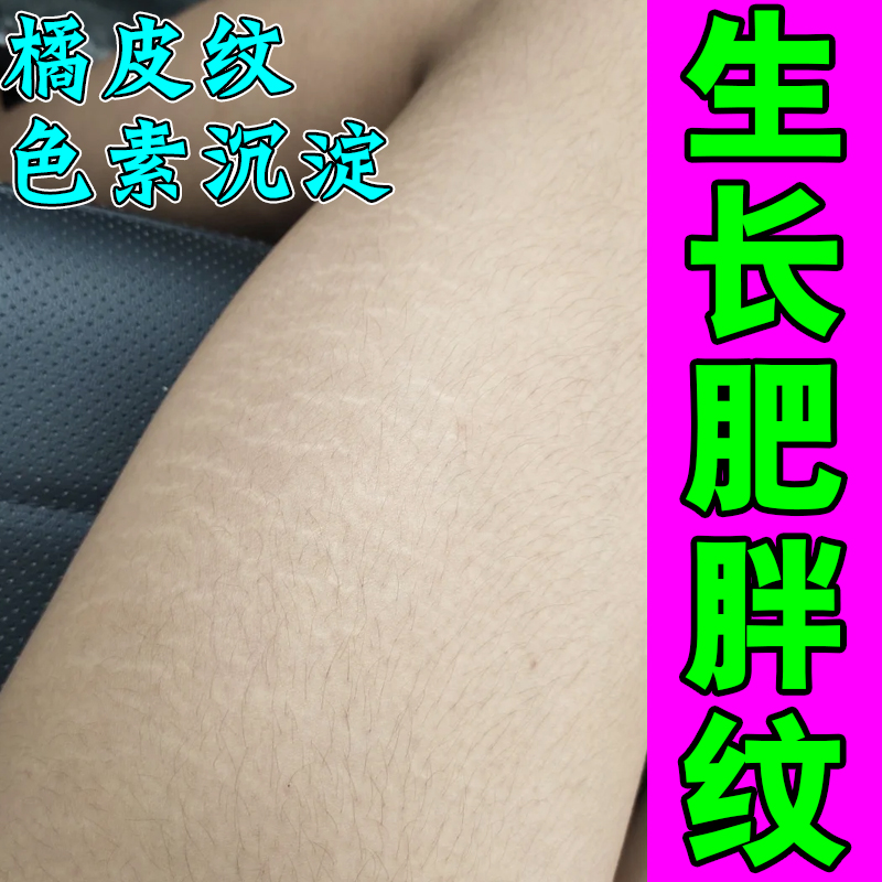 去肥胖纹生长纹修复霜消除大腿学生腰腹上肥胖纹去除男女通用药膏