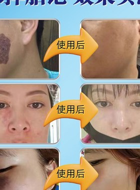 胎记去除神器遮胎记去除膏去胎记除胎记脸部咖啡斑去除淡化遮瑕膏