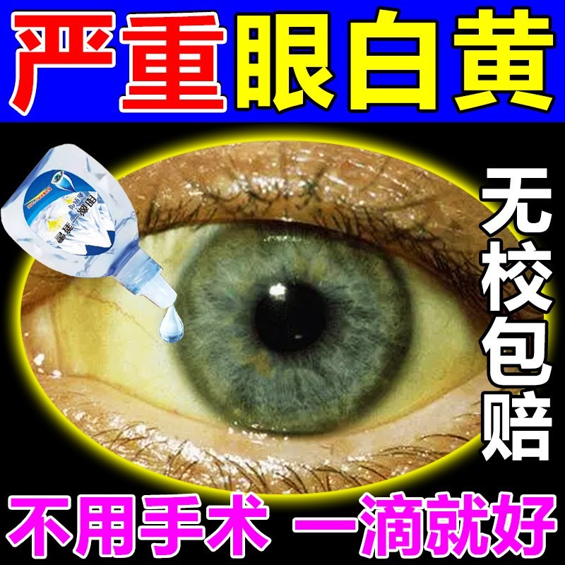 眼白发黄滴眼液改善眼底黄斑病变眼白水肿去黄混浊红血丝疲劳干涩