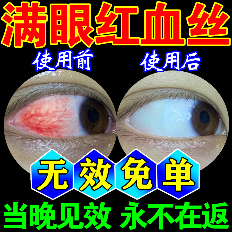 眼睛红血丝修复去除黄眼水消除眼屎多粘稠眼膏缓解眼疲劳滴眼液