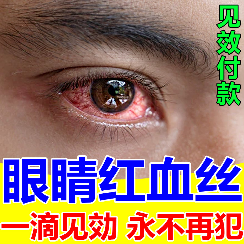 眼睛红血丝修复去除眼睛去黄去红血丝缓解眼疲劳眼水粘稠滴眼液