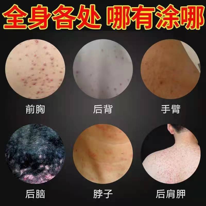 头毛囊焱头部焱痤头上脸部前胸後背长疙瘩痘痘除蟎专用