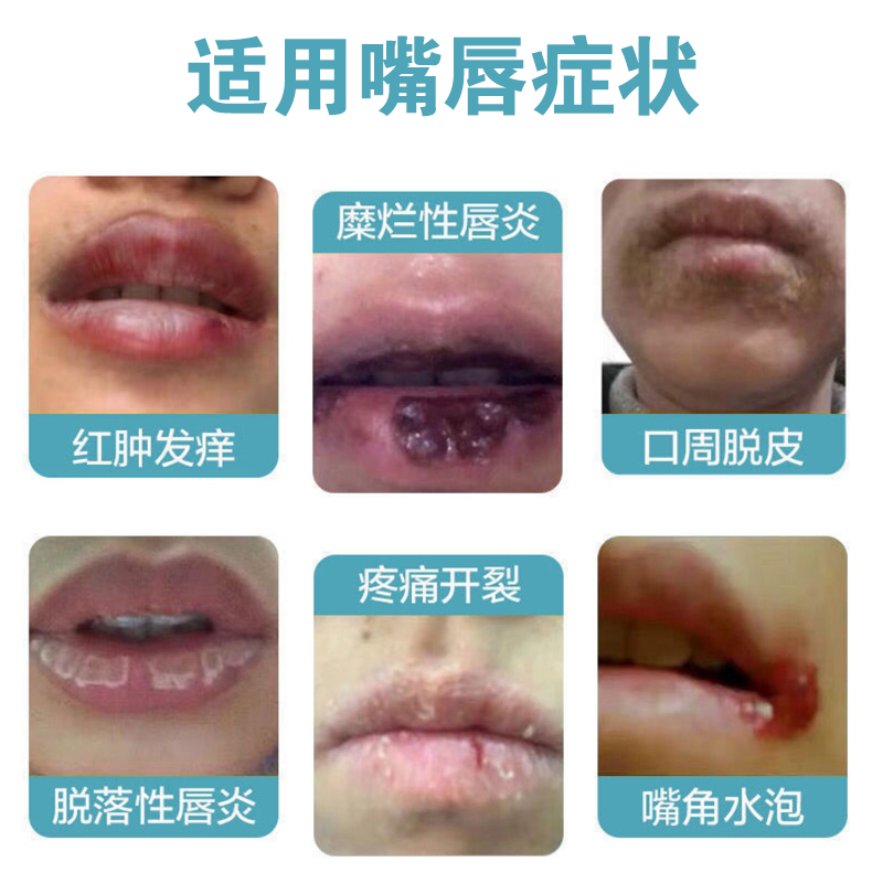 口周唇炎润唇膏嘴唇圈红乾裂脱皮出血起唇炎膏儿童舔嘴唇专用