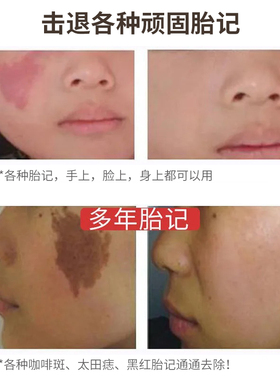 胎记去除神器脸部遮祛专用淡化咖啡斑遗传斑太田痣婴儿黑色素褐色