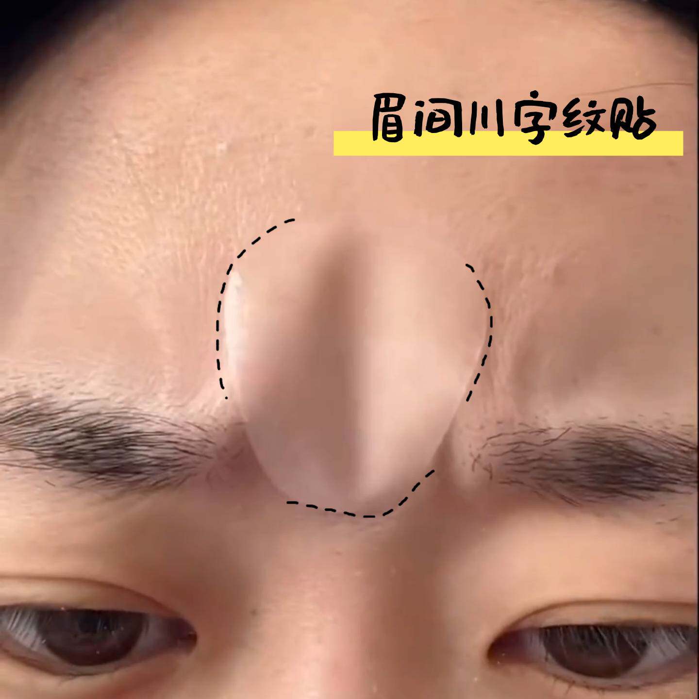川字纹贴睡觉专用眉间额头贴面部提拉隐形贴紧致抬头纹防皱纹神器
