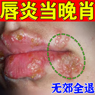 口周唇炎润唇膏嘴唇圈红乾裂脱皮出血起唇炎膏儿童舔嘴唇专用