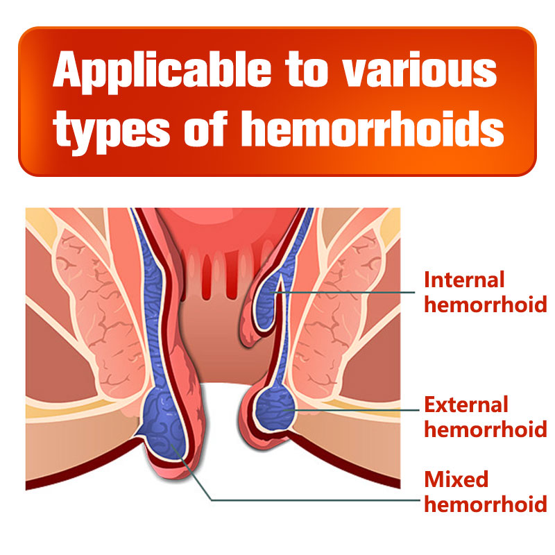 Hemorrhoids Ointment  fast Therapy Shrinks and soothes hemor