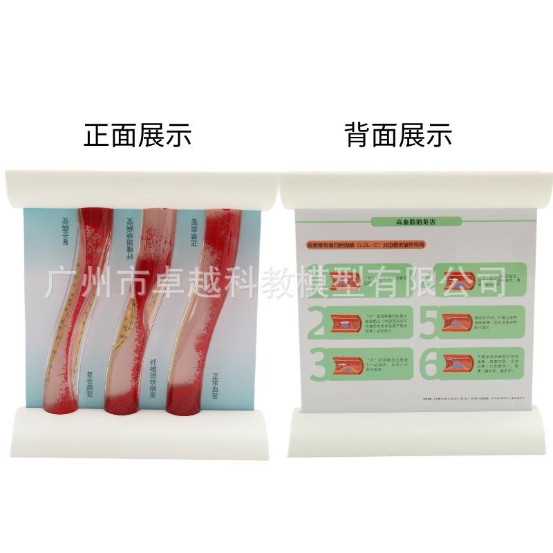 直销新款人体支脉粥样堵塞心血管模型血栓血液浓度脂肪病理粥样硬
