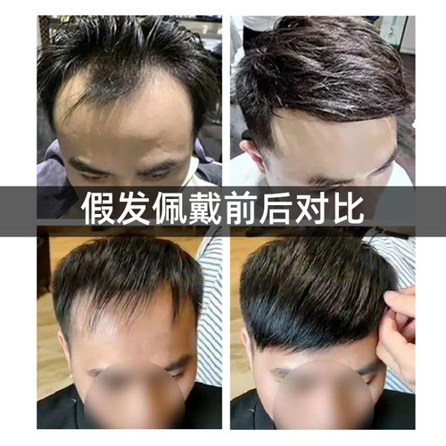生物头皮假发男短发全真发头顶前额补发光头N秃顶超薄隐形男士假