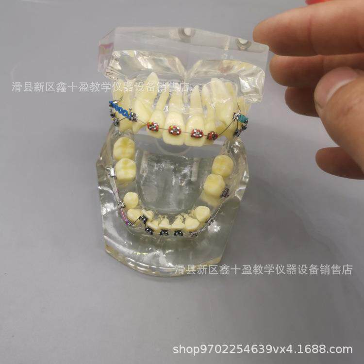 齿托VUK畸模型缺失牙错颌牙列不齐矫正金牙正属槽带支抗牵引皮拉