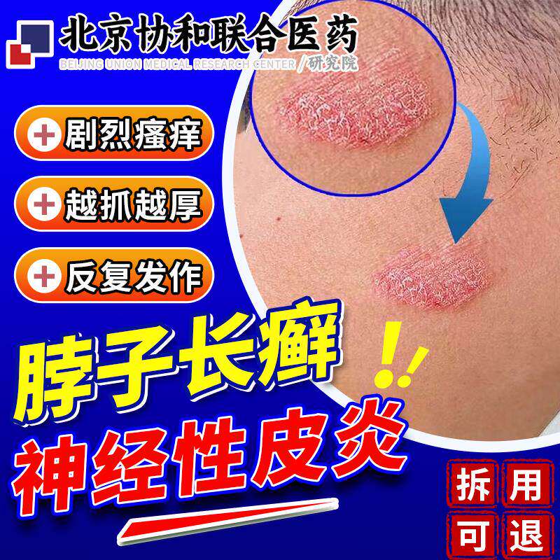 脖子上长癣痒神经性皮炎外