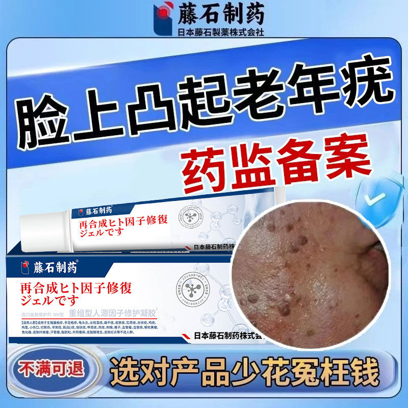 去脸上凸起老年斑人疣扁平