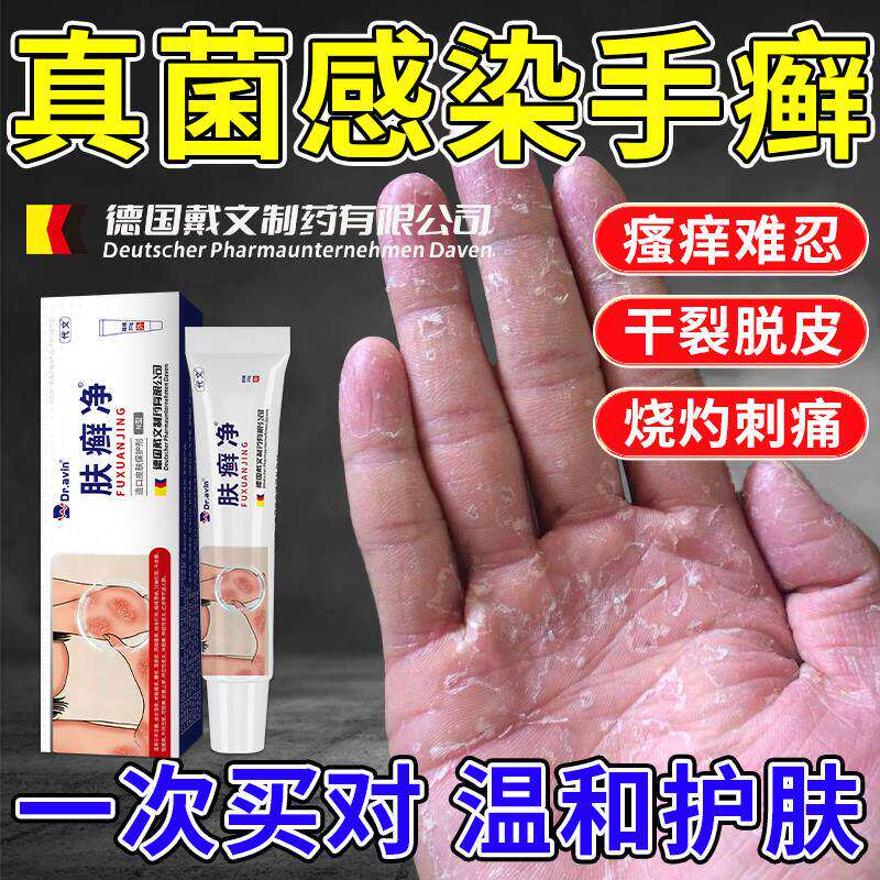 手癣膏脱皮干裂真菌感染烂