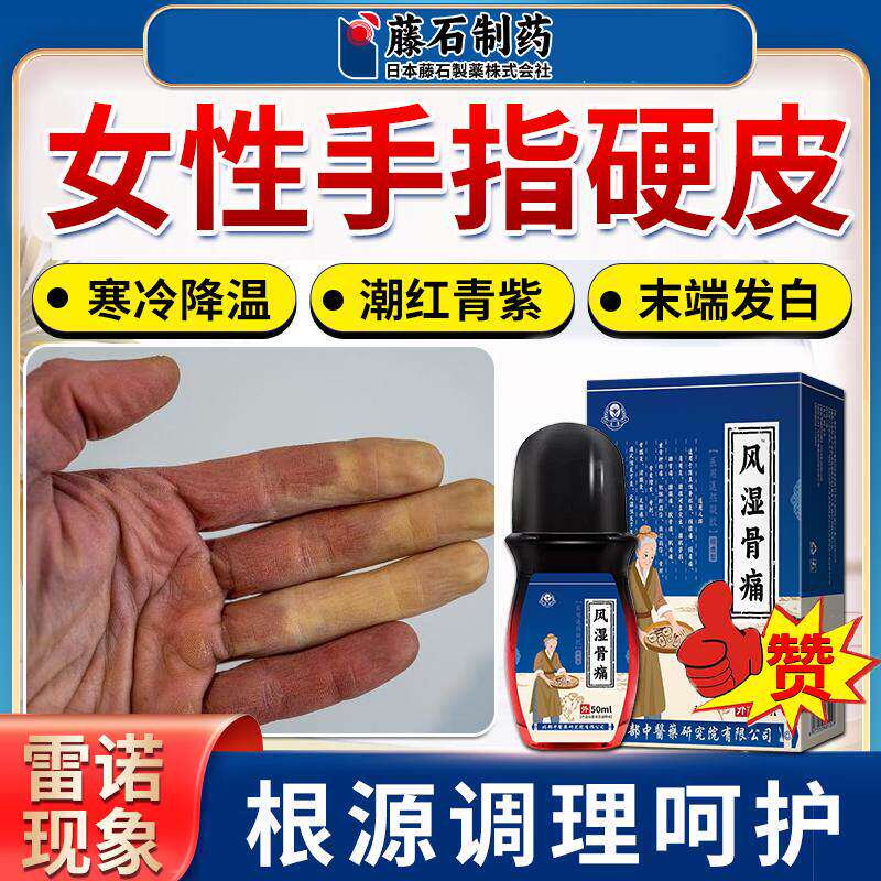 女性类风湿雷诺现象手指硬