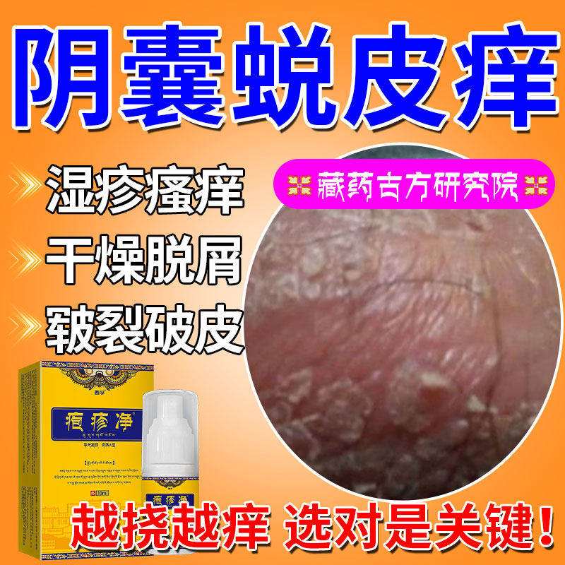 男士阴囊痒脱皮潮湿疹瘙可