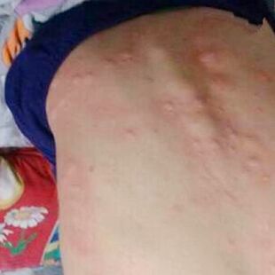 极速浑身发c痒身上起红点皮肤痒全身疙瘩身上痒疙瘩过敏性皮肤瘙