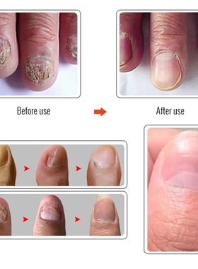 极速Nail Fungus atment Feet Care Essence NailPs Foot Repair