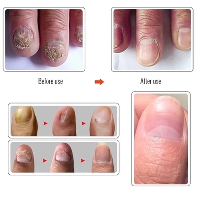 极速Nail Fungus atment Feet Care Essence NailPs Foot Repair
