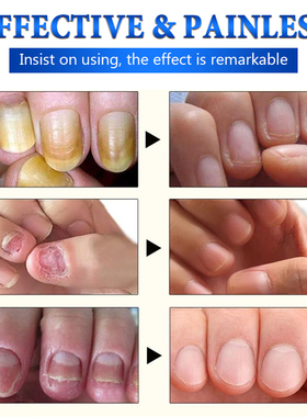 极速Nova atualiza??o prego repara?H?o lquido fungo tra