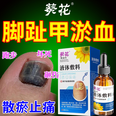 手脚趾甲淤血指甲被夹被砸甲床受损坏死变形生长液甲下淤血发黑u9