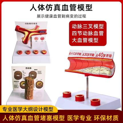 冠状动脉性心血管动脉模型硬化模型 人体病理模型血栓模型