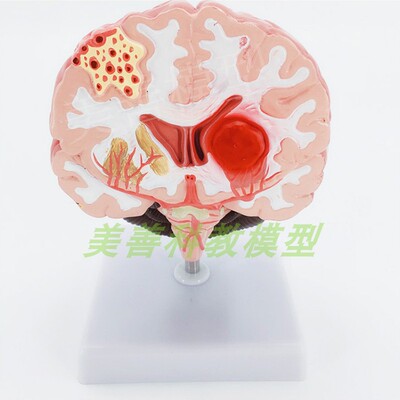 极速人体脑解剖模型 脑中风 脑出血 动脉瘤 大脑T动静脉畸形脑病