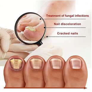 极速iBeaLee 7DAYS Repair Nawil Fungus Treatments Essence Foo