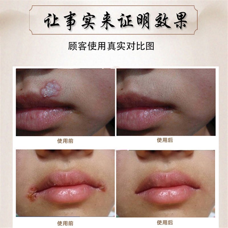 极速嘴唇嘴角唇炎小水泡口角乾裂糜烂脓N疮痒痛修复润唇膏.