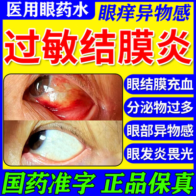【瑞眸舒】硫酸锌尿囊素滴眼液8ml*1支/盒