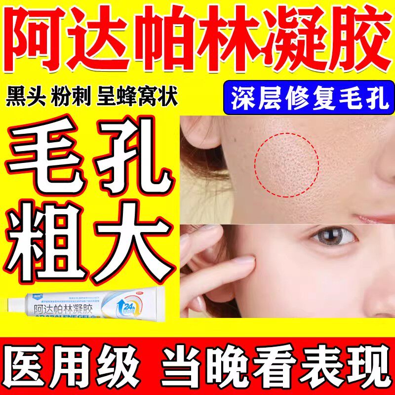 【鑫烨】阿达帕林凝胶0.1%*10g*1支/盒