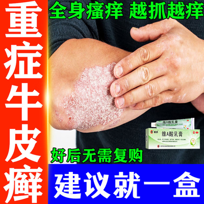 顽固牛皮癣银屑病专用药膏外用 皮肤瘙痒起皮癣维A酸乳膏医用