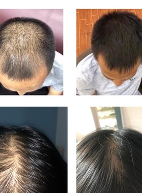 极速Ginger Haiir Growth Hair Essential Oil Prevent Hair Loss