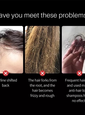 极速3PCS Ginger Hair Growth Essence Oils Anti QLoss Treateme