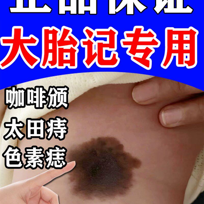 新品胎记去除神器太田痔淡化咖啡斑黑色素脸部褐S色沉淀祛//斑膏