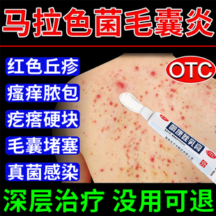 酮康唑乳膏正品治背后长痘痘后背马拉色菌毛囊炎真菌感染专用药膏