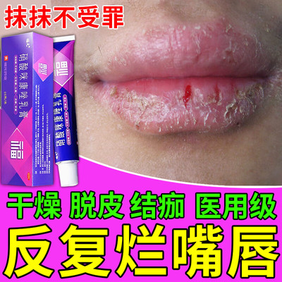 唇炎专用药膏唇炎唇膏嘴唇干裂脱皮修护唇炎烂嘴角口角炎医用