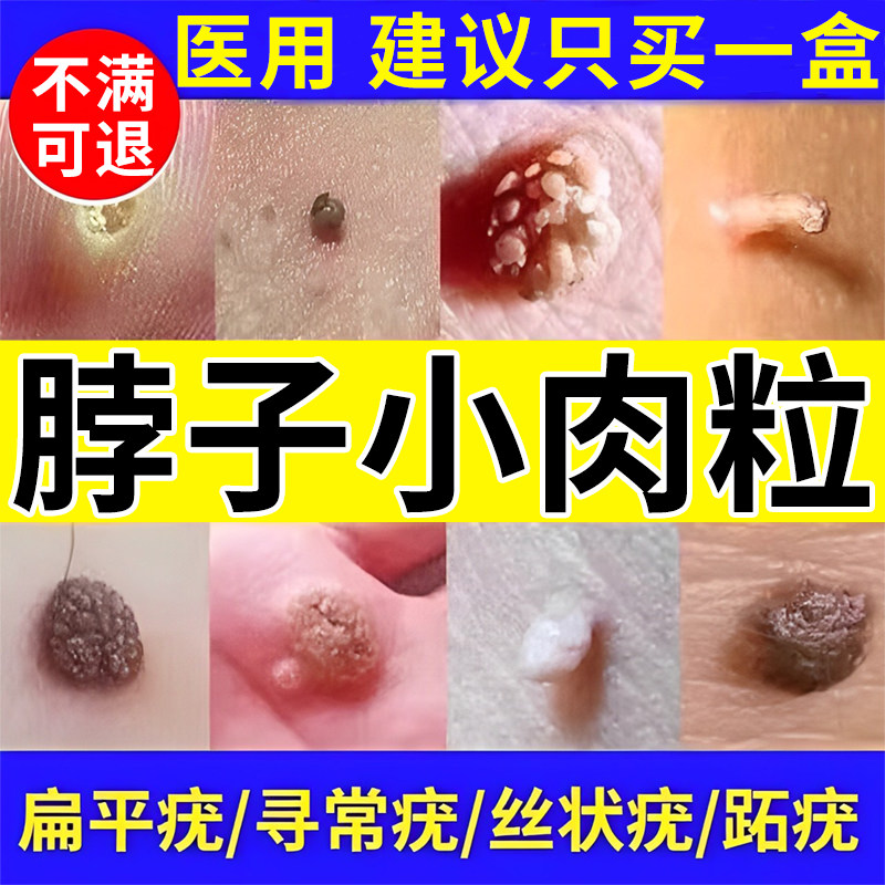 扁平疣专用药膏去看根面颈部疣瘊猴子肉粒疙瘩去看除维A酸乳膏