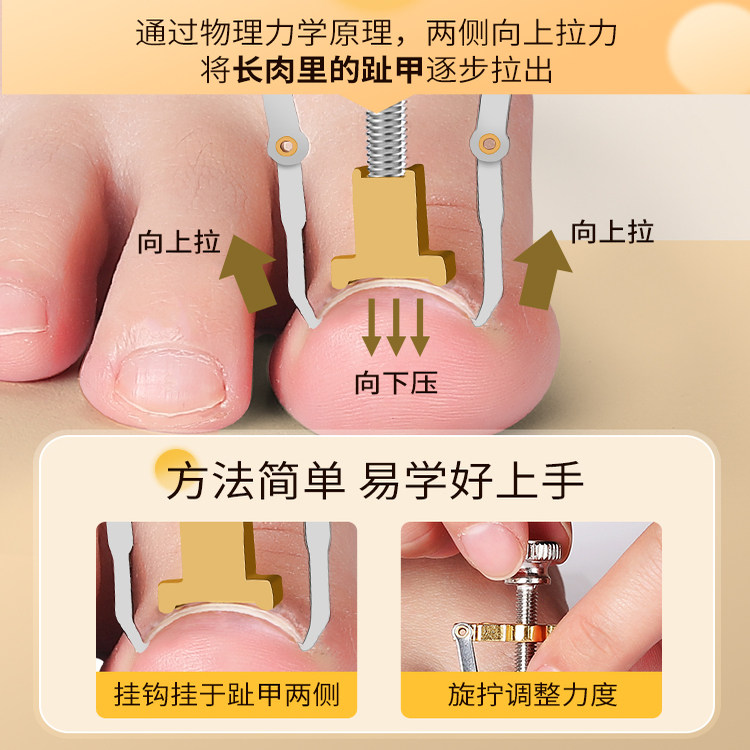 甲沟嵌甲矫正器防脚指甲长肉里