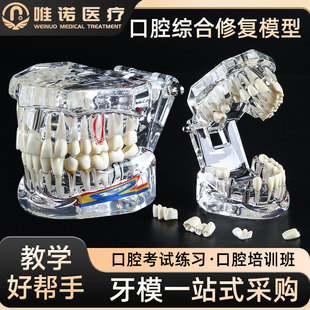牙科修复模型口腔病理医患沟通教学修复综合带神经部分可拆卸牙模