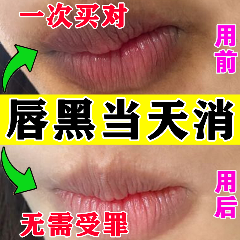 淡化唇纹去除嘴角暗沉色素