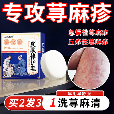 荨麻疹香皂过敏止痒断根提升免疫力急慢性丘疹性寻荨麻疹非专用药