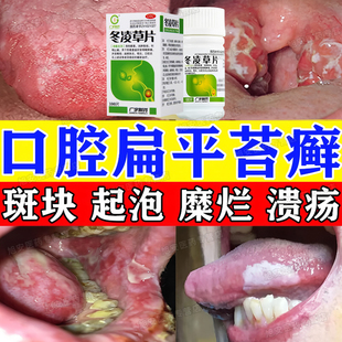 口腔炎舌头溃疡特专用效药口腔扁平苔藓专辅助用药治疗黏膜炎修复