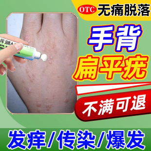 维a酸乳膏医用去疣手背去扁平疣丝状疣特专用效药膏去除膏一抹灵