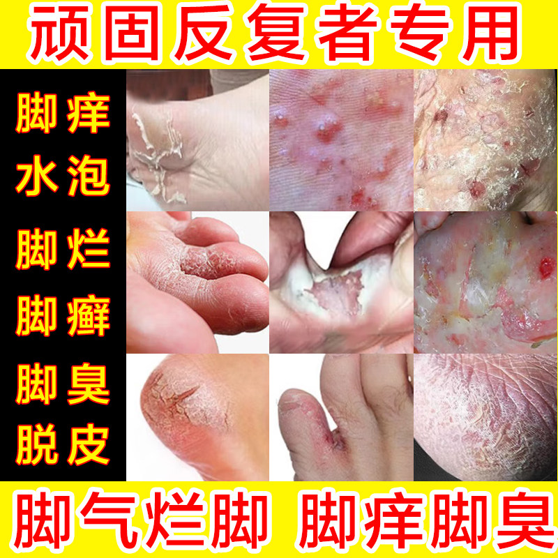 脚底水泡烂脚丫脚汽止痒脱皮杀菌真菌感染喷雾脚汗除脚异味去痒膏