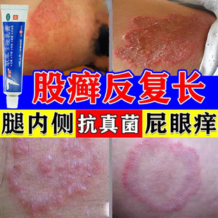股癣专用药膏股藓大腿根内侧真菌感染阴囊潮湿脱屑丘疹水疱瘙痒A