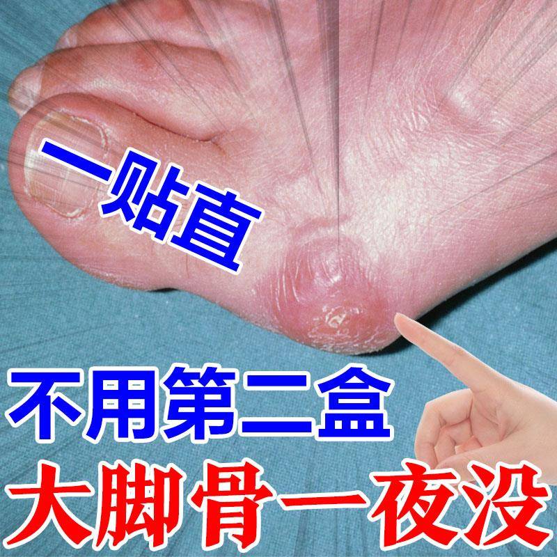 拇指外翻药膏贴大脚骨变形矫正脚趾重贴脚骨拐大拇指关节疼专用药